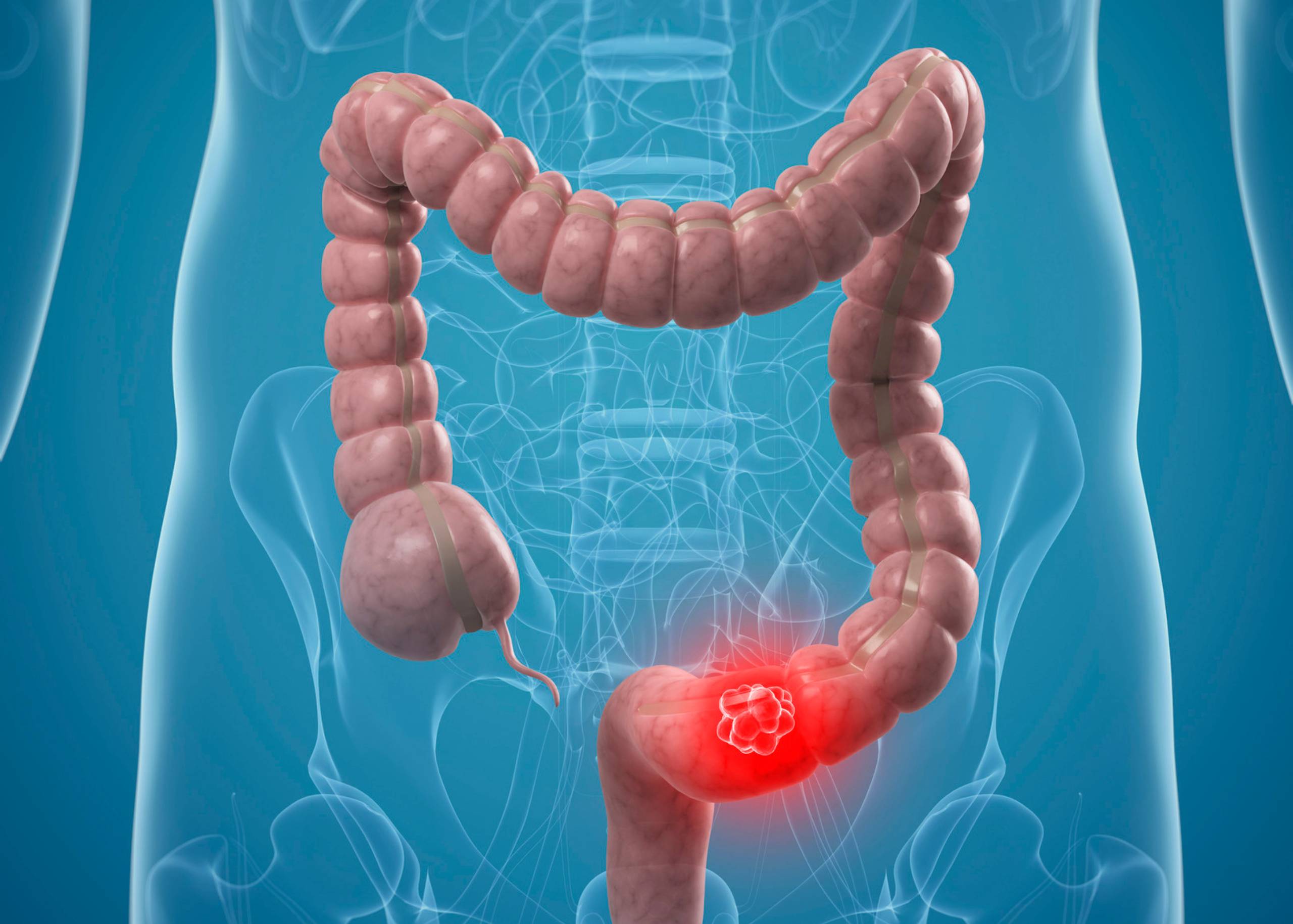 Colon Cancer