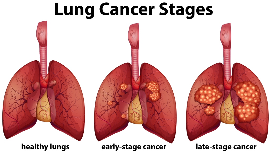 Lungs Cancer