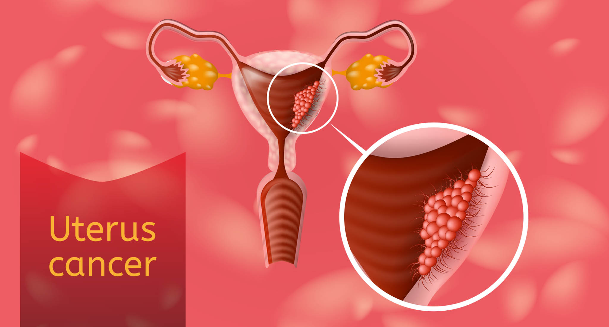 Uterus Cancer