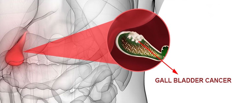 Gall bladder cancer naturopathy in nagpur