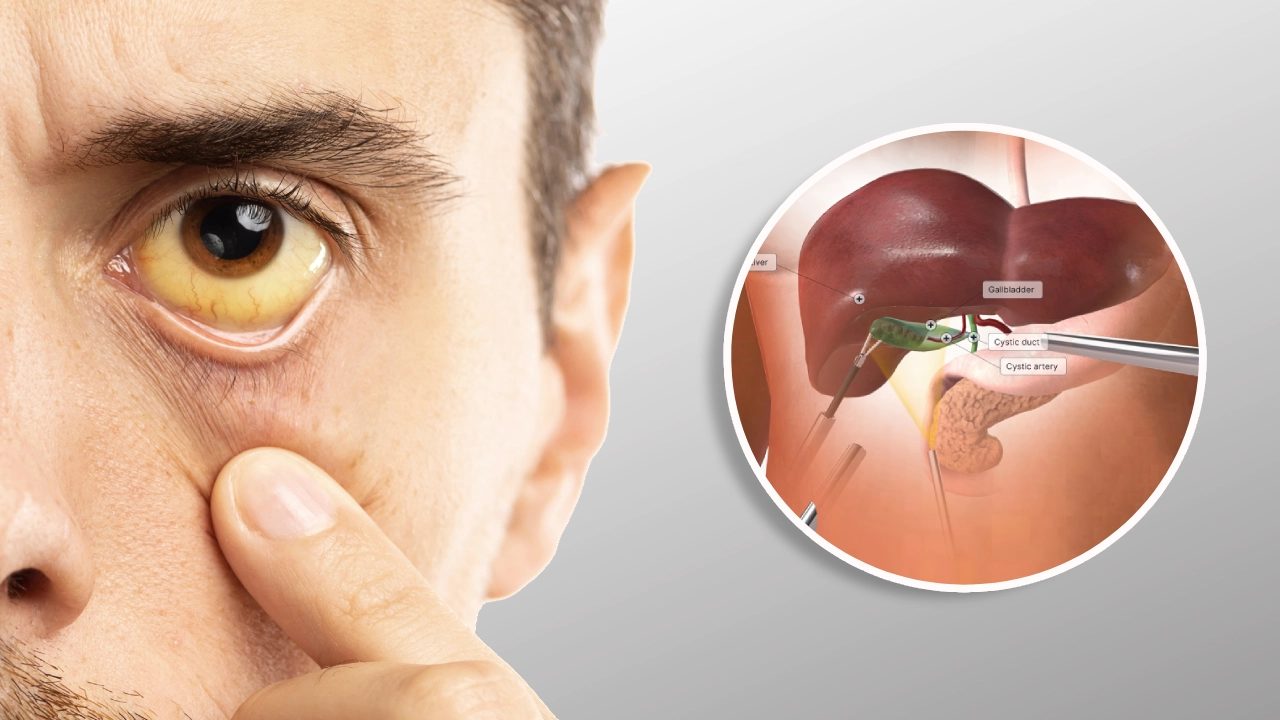 Jaundice naturopathy treatment in nagpur